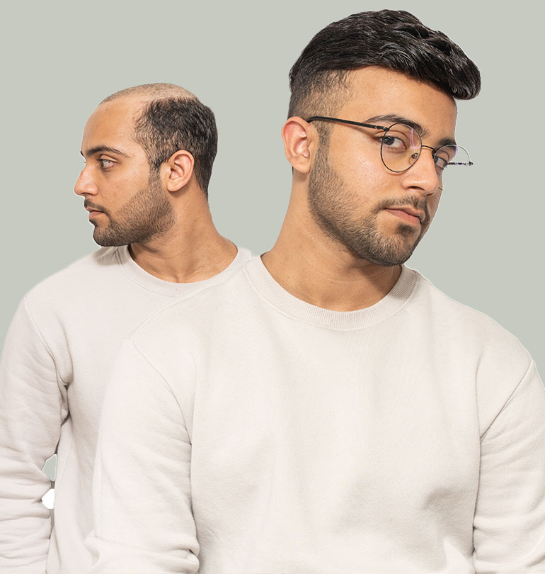 Sistemas de cabello para hombres Sistemas de cabello para hombres